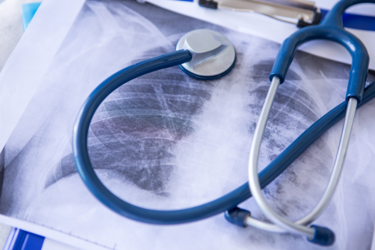 Polmoniti interstiziali, ATS/ERS aggiornano la loro classificazione 